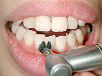 歯面の研磨・清掃