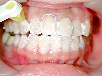 歯面の研磨・清掃
